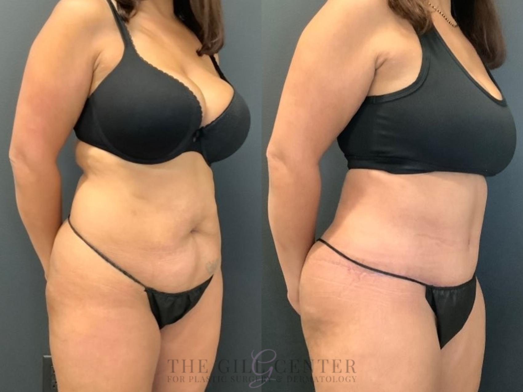 Tummy Tuck Case 492 Before & After Right Oblique | The Woodlands, TX | The Gill Center for Plastic Surgery and Dermatology