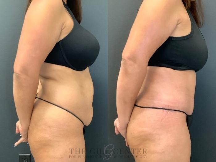 Tummy Tuck Case 492 Before & After Right Side | The Woodlands, TX | The Gill Center for Plastic Surgery and Dermatology