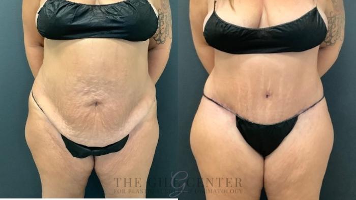 Tummy Tuck Case 496 Before & After Front | The Woodlands, TX | The Gill Center for Plastic Surgery and Dermatology