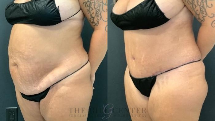 Tummy Tuck Case 496 Before & After Left Oblique | The Woodlands, TX | The Gill Center for Plastic Surgery and Dermatology