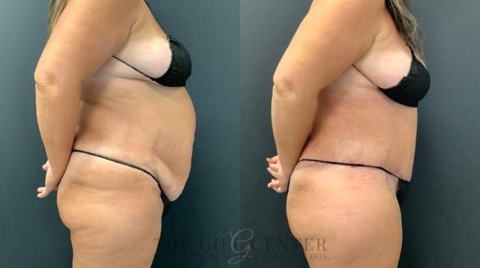 Tummy Tuck Case 496 Before & After Right Side | The Woodlands, TX | The Gill Center for Plastic Surgery and Dermatology