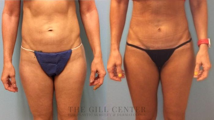 Tummy Tuck Case 497 Before & After Front | The Woodlands, TX | The Gill Center for Plastic Surgery and Dermatology