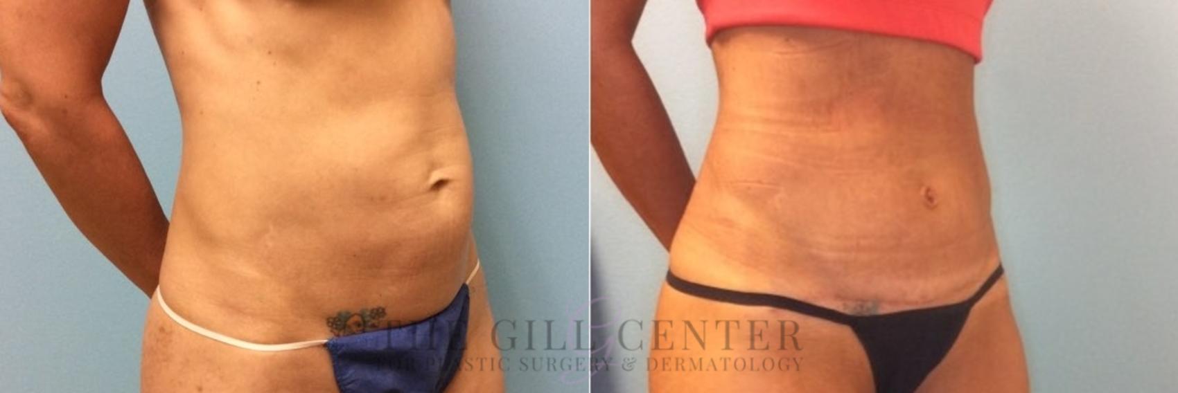 Tummy Tuck Case 497 Before & After Right Oblique | The Woodlands, TX | The Gill Center for Plastic Surgery and Dermatology