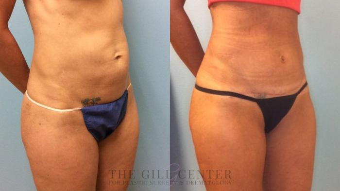 Tummy Tuck Case 497 Before & After Right Oblique | The Woodlands, TX | The Gill Center for Plastic Surgery and Dermatology