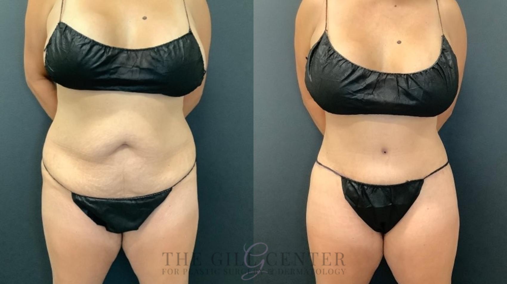 Tummy Tuck Case 499 Before & After Front | The Woodlands, TX | The Gill Center for Plastic Surgery and Dermatology