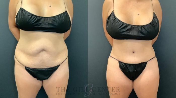 Tummy Tuck Case 499 Before & After Front | The Woodlands, TX | The Gill Center for Plastic Surgery and Dermatology