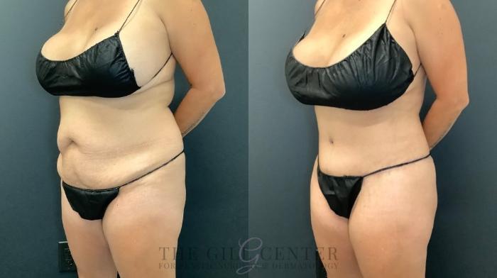 Tummy Tuck Case 499 Before & After Left Oblique | The Woodlands, TX | The Gill Center for Plastic Surgery and Dermatology