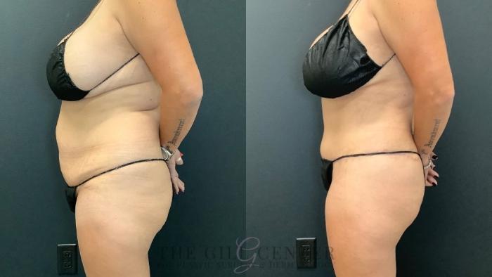 Tummy Tuck Case 499 Before & After Left Side | The Woodlands, TX | The Gill Center for Plastic Surgery and Dermatology