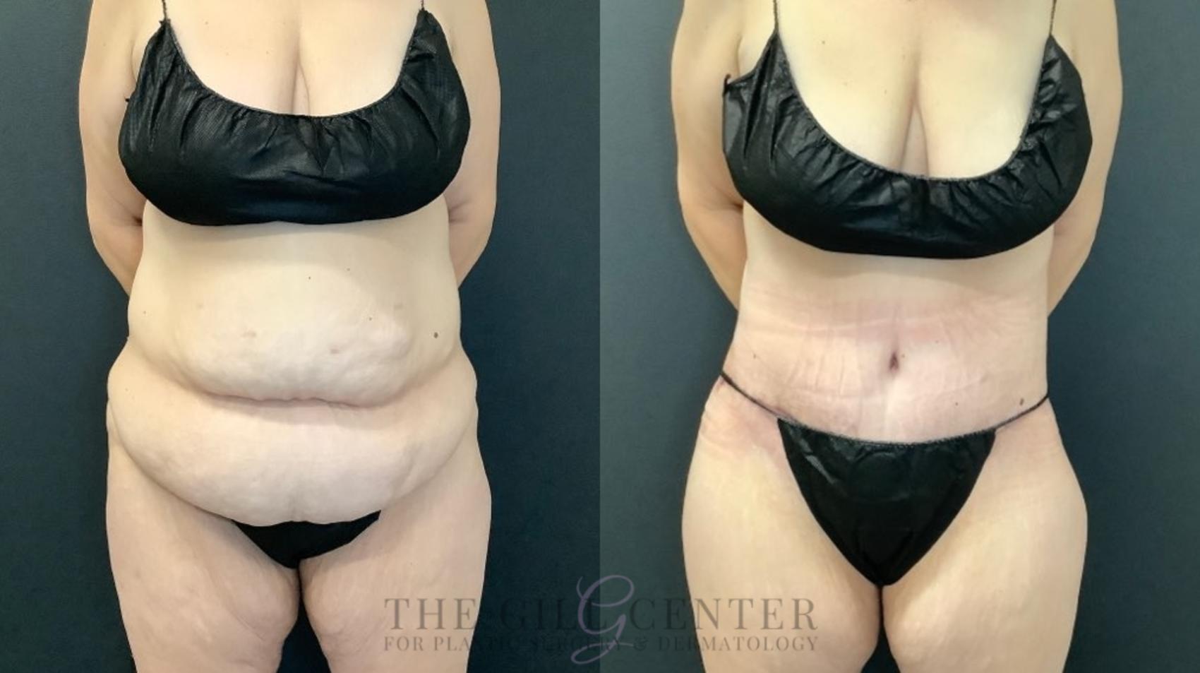 Tummy Tuck Case 501 Before & After Front | The Woodlands, TX | The Gill Center for Plastic Surgery and Dermatology