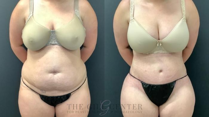 Tummy Tuck Case 515 Before & After Front | The Woodlands, TX | The Gill Center for Plastic Surgery and Dermatology
