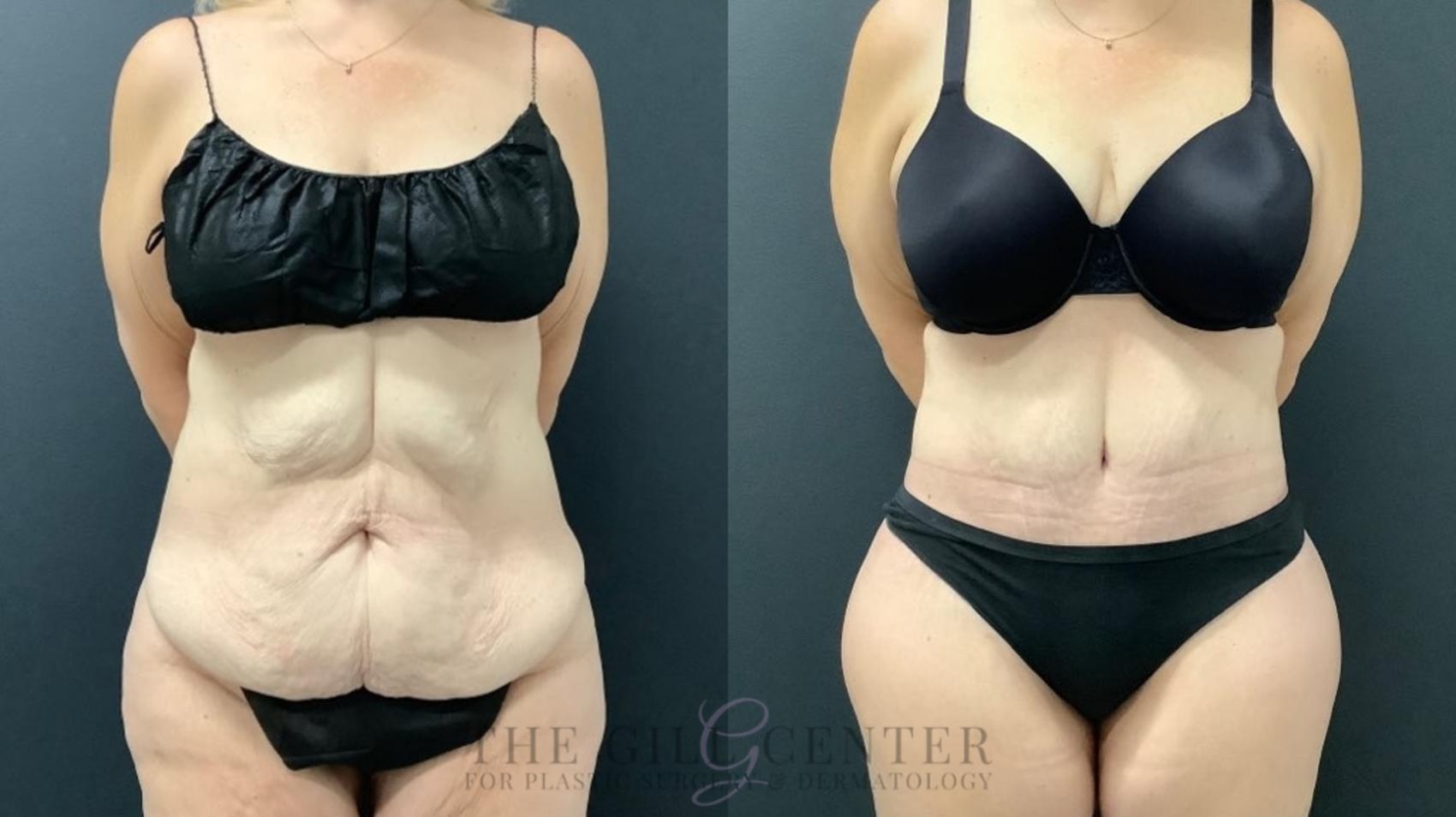 Tummy Tuck Case 520 Before & After Front | The Woodlands, TX | The Gill Center for Plastic Surgery and Dermatology