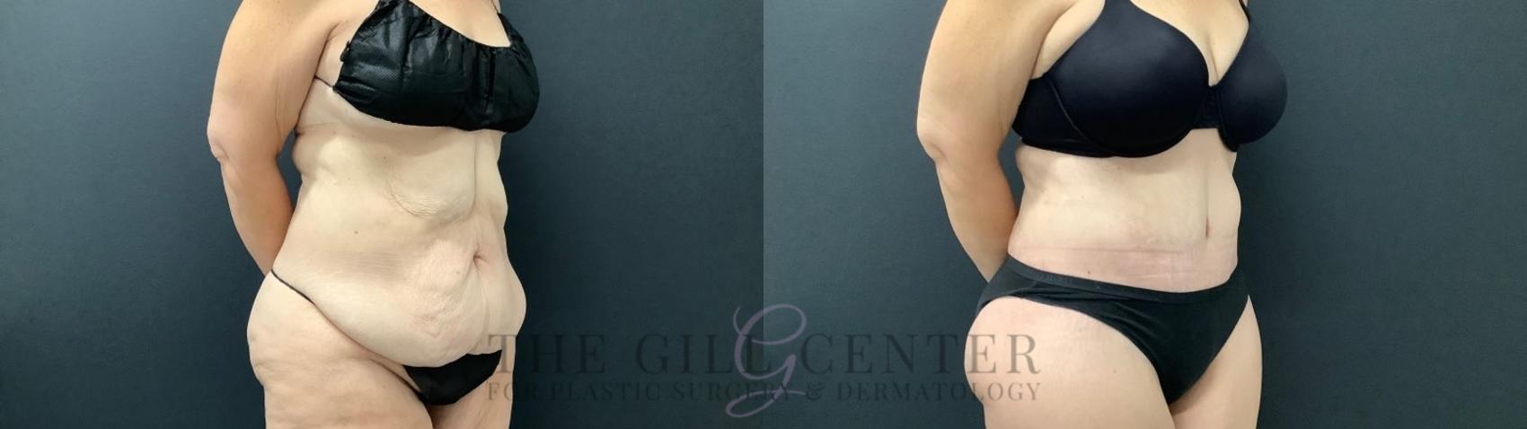 Tummy Tuck Case 520 Before & After Right Three-quarter view | The Woodlands, TX | The Gill Center for Plastic Surgery and Dermatology