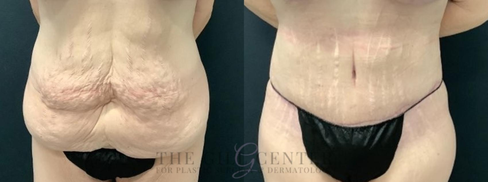 Tummy Tuck Case 524 Before & After Front | The Woodlands, TX | The Gill Center for Plastic Surgery and Dermatology