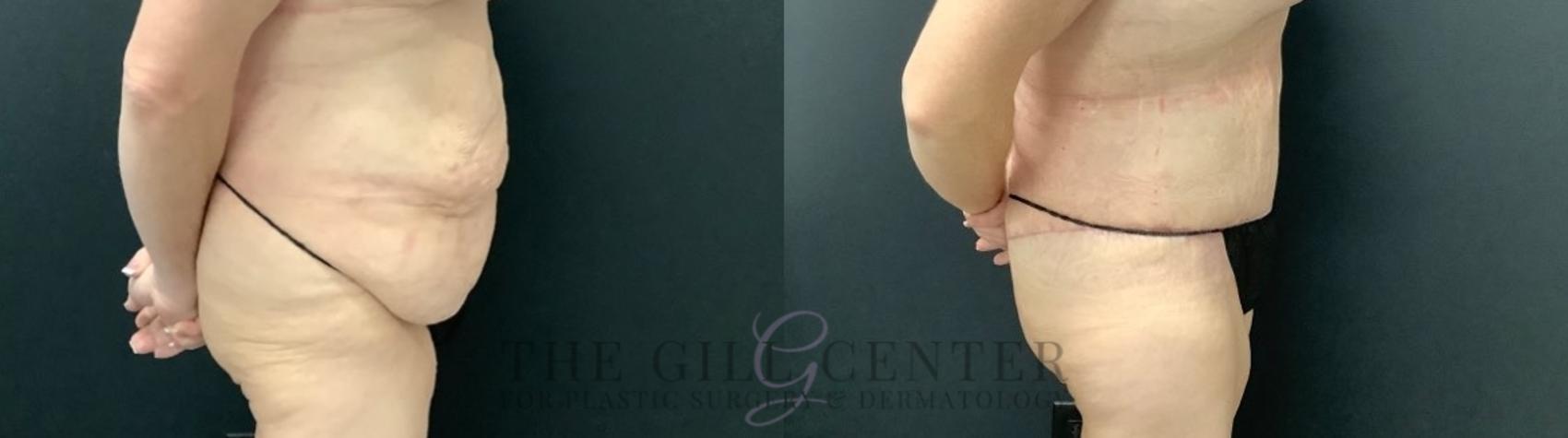 Tummy Tuck Case 524 Before & After Right Side | The Woodlands, TX | The Gill Center for Plastic Surgery and Dermatology