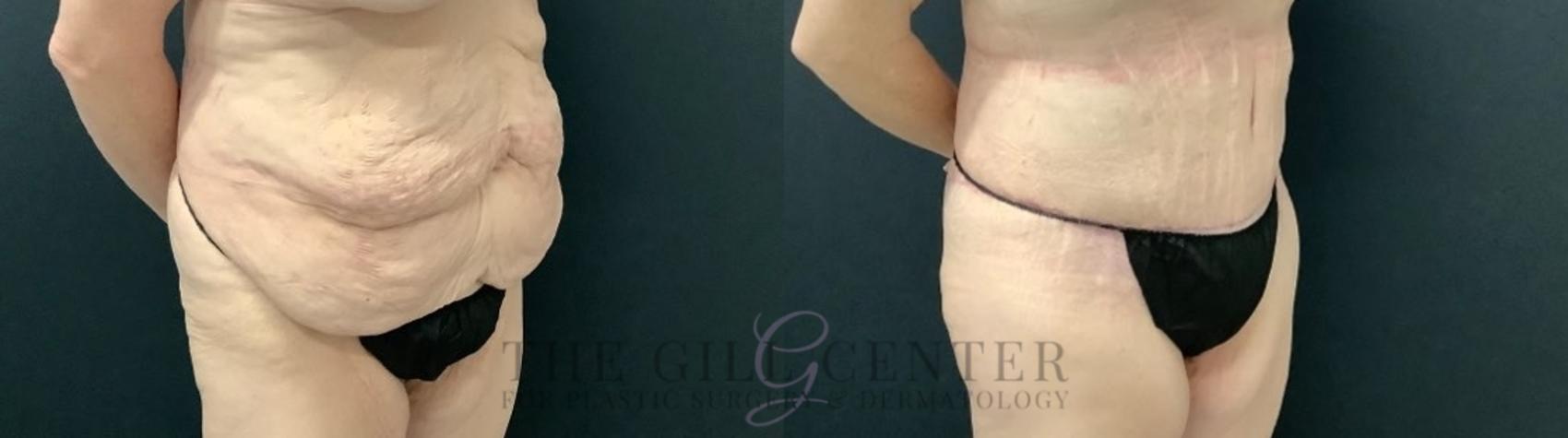 Tummy Tuck Case 524 Before & After Right Three-quarter view | The Woodlands, TX | The Gill Center for Plastic Surgery and Dermatology