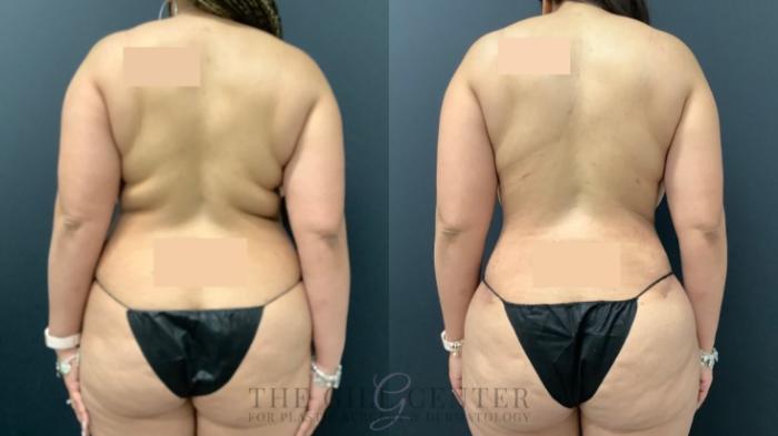 Tummy Tuck Case 534 Before & After Back | The Woodlands, TX | The Gill Center for Plastic Surgery and Dermatology