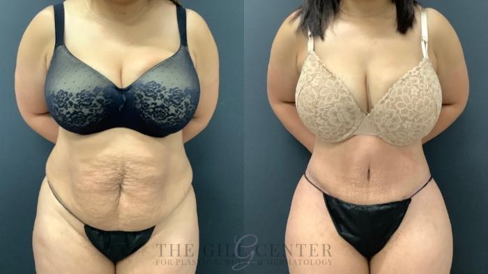 Tummy Tuck Case 534 Before & After Front | The Woodlands, TX | The Gill Center for Plastic Surgery and Dermatology