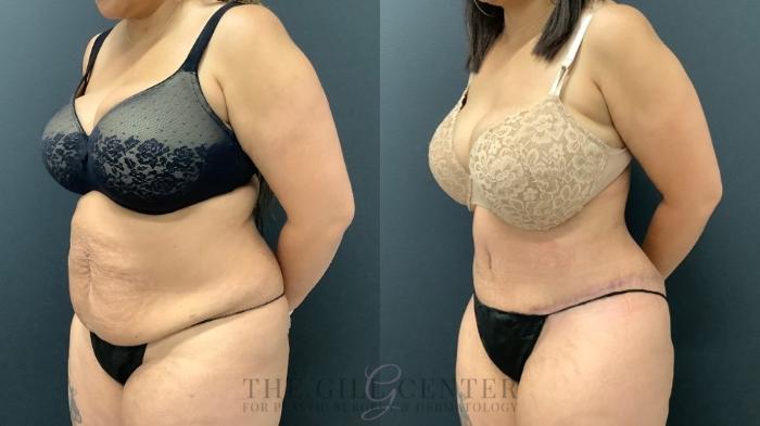 Tummy Tuck Case 534 Before & After Left Oblique | The Woodlands, TX | The Gill Center for Plastic Surgery and Dermatology