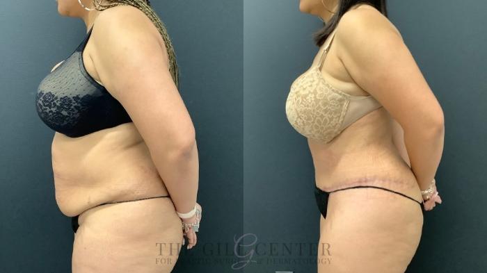 Tummy Tuck Case 534 Before & After Right Side | The Woodlands, TX | The Gill Center for Plastic Surgery and Dermatology