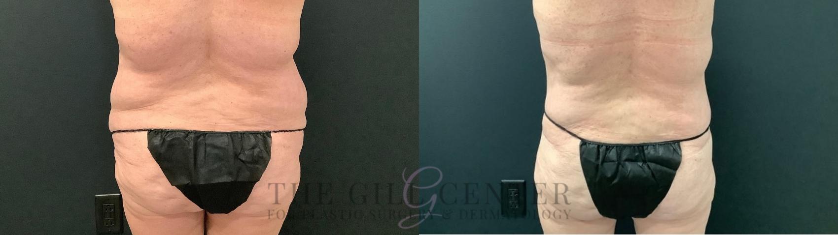 Tummy Tuck Case 540 Before & After Back | The Woodlands, TX | The Gill Center for Plastic Surgery and Dermatology