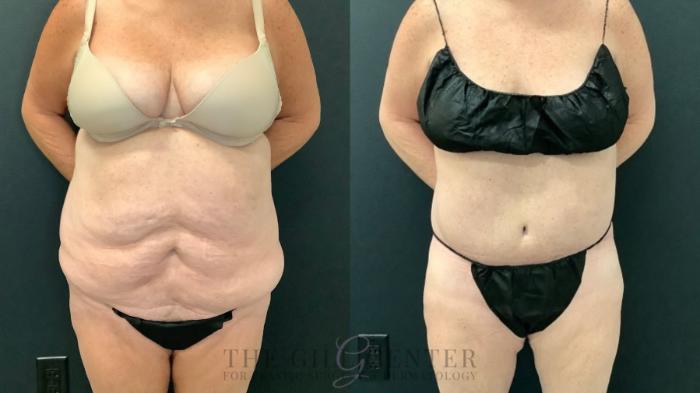 Tummy Tuck Case 540 Before & After Front | The Woodlands, TX | The Gill Center for Plastic Surgery and Dermatology