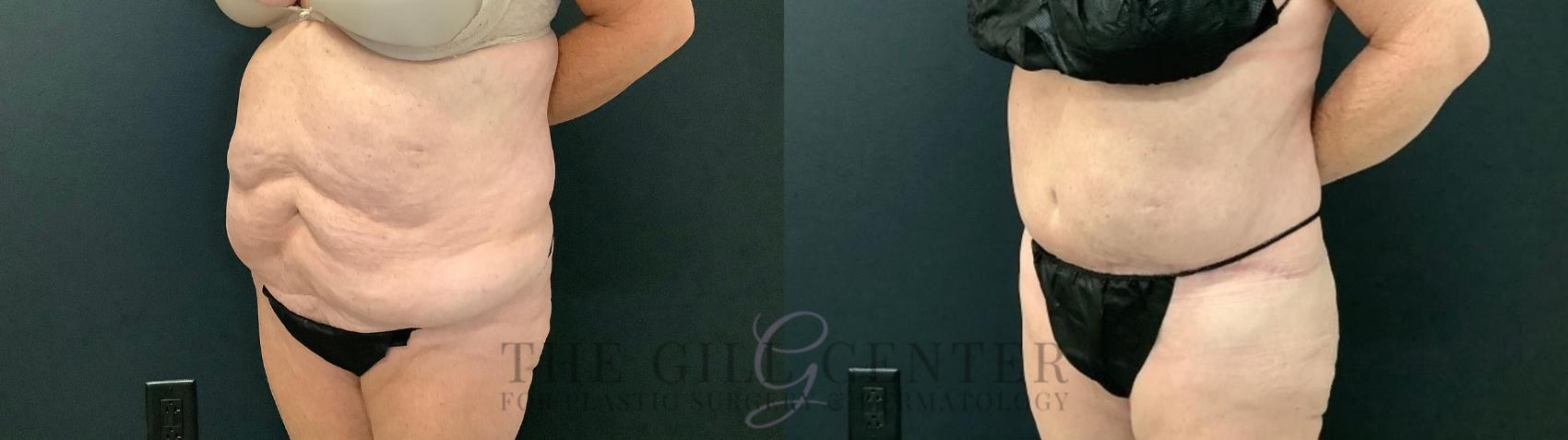 Tummy Tuck Case 540 Before & After Left Oblique | The Woodlands, TX | The Gill Center for Plastic Surgery and Dermatology