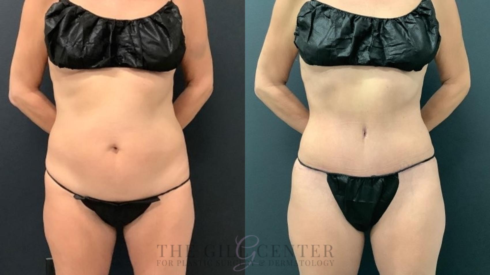 Tummy Tuck Case 551 Before & After Front | The Woodlands, TX | The Gill Center for Plastic Surgery and Dermatology