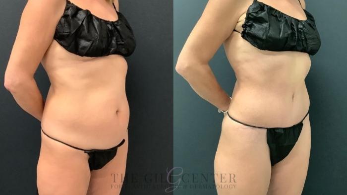 Tummy Tuck Case 551 Before & After Right Oblique | The Woodlands, TX | The Gill Center for Plastic Surgery and Dermatology