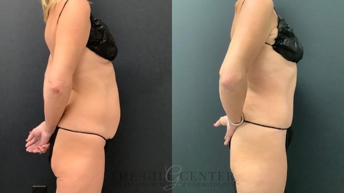 Tummy Tuck Case 551 Before & After Right Side | The Woodlands, TX | The Gill Center for Plastic Surgery and Dermatology
