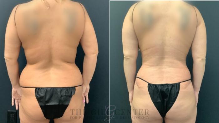 Tummy Tuck Case 554 Before & After Back | The Woodlands, TX | The Gill Center for Plastic Surgery and Dermatology