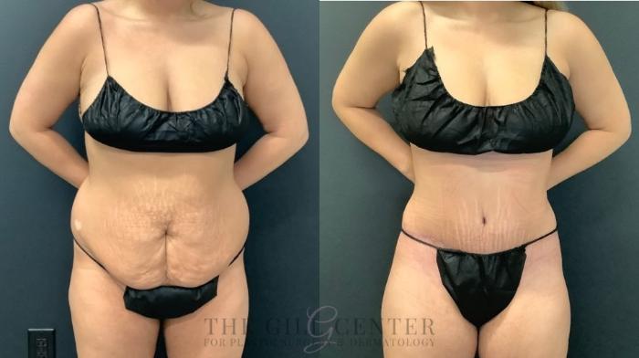 Tummy Tuck Case 554 Before & After Front | The Woodlands, TX | The Gill Center for Plastic Surgery and Dermatology