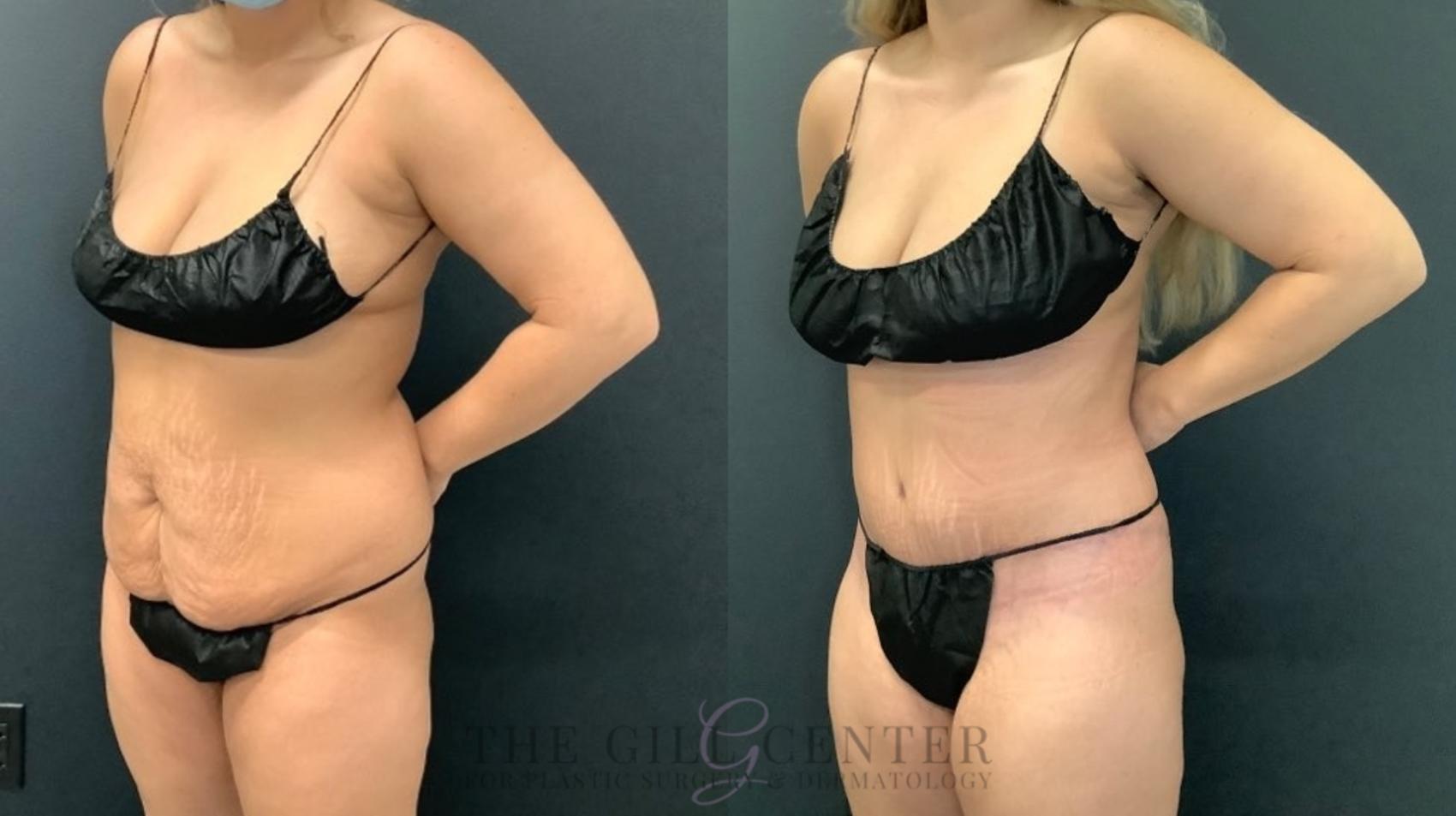 Tummy Tuck Case 554 Before & After Left Oblique | The Woodlands, TX | The Gill Center for Plastic Surgery and Dermatology