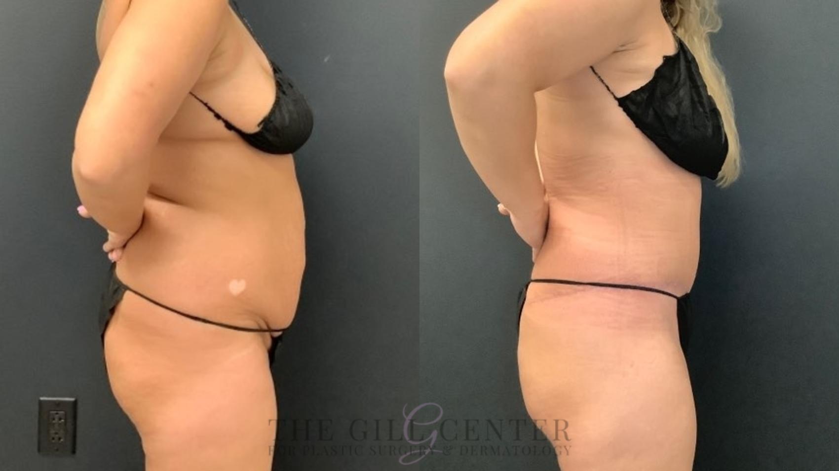 Tummy Tuck Case 554 Before & After Right Side | The Woodlands, TX | The Gill Center for Plastic Surgery and Dermatology