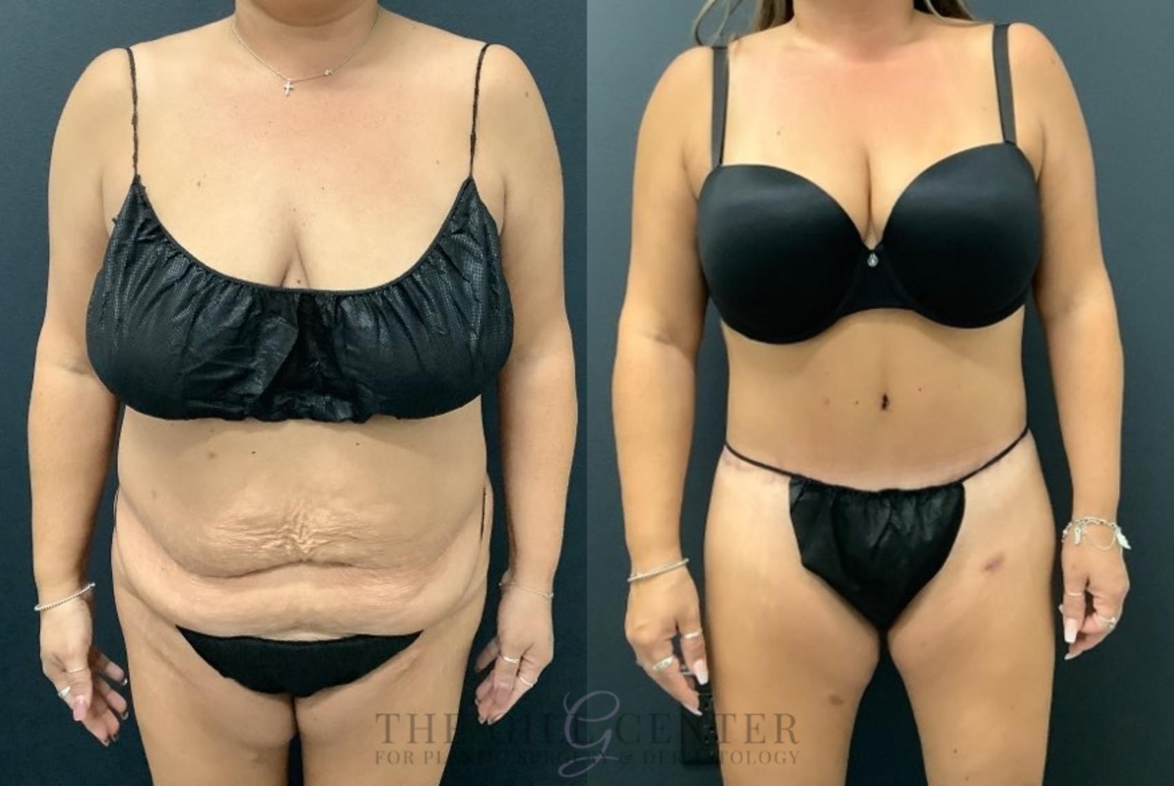 Tummy Tuck Case 559 Before & After Front | The Woodlands, TX | The Gill Center for Plastic Surgery and Dermatology