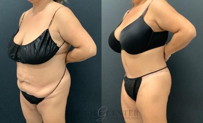 Tummy Tuck Case 559 Before & After Left Oblique | The Woodlands, TX | The Gill Center for Plastic Surgery and Dermatology