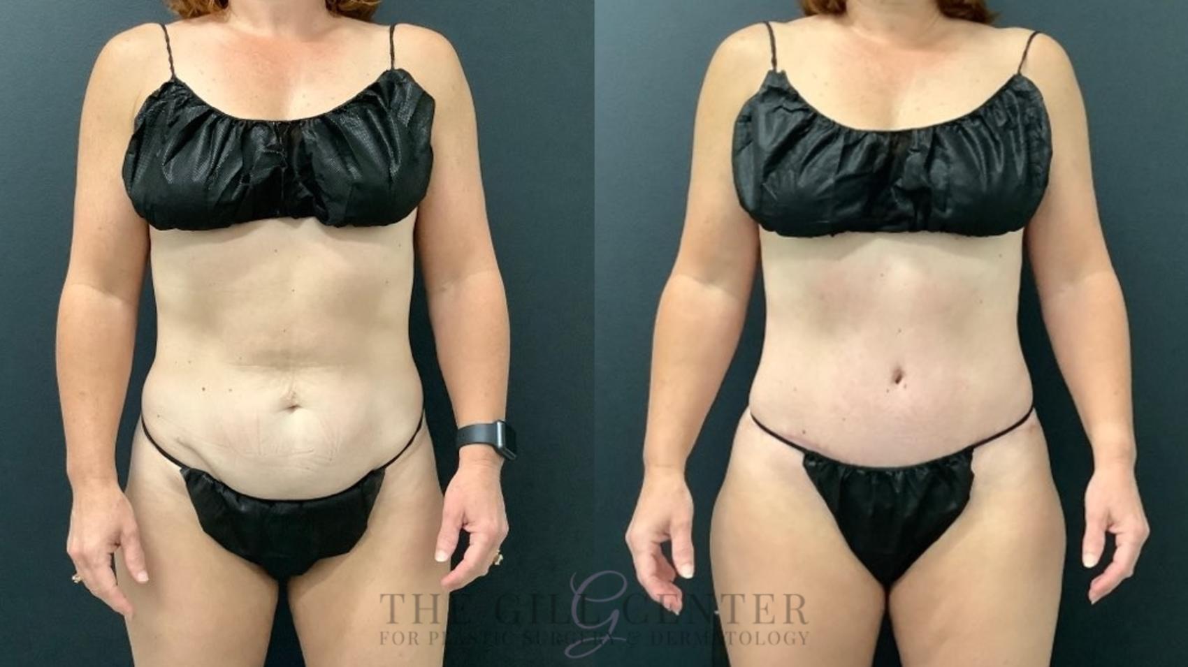 Tummy Tuck Case 565 Before & After Front | The Woodlands, TX | The Gill Center for Plastic Surgery and Dermatology