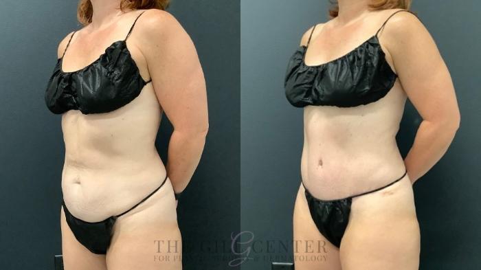 Tummy Tuck Case 565 Before & After Left Oblique | The Woodlands, TX | The Gill Center for Plastic Surgery and Dermatology