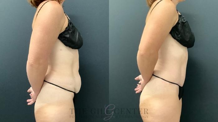 Tummy Tuck Case 565 Before & After Right Side | The Woodlands, TX | The Gill Center for Plastic Surgery and Dermatology