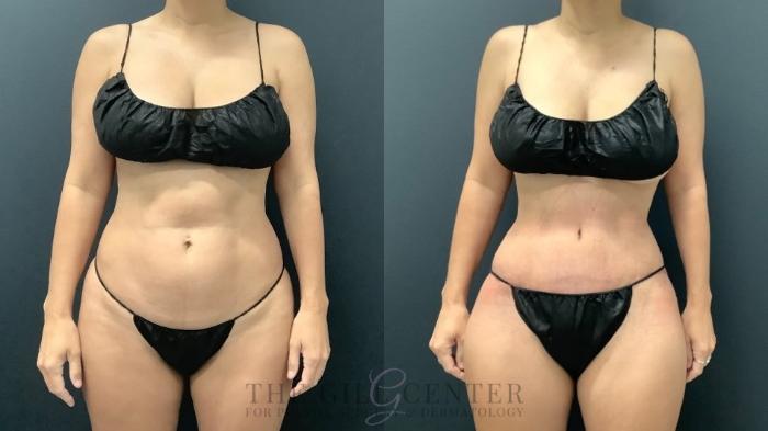 Tummy Tuck Case 566 Before & After Front | The Woodlands, TX | The Gill Center for Plastic Surgery and Dermatology