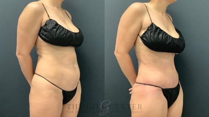 Tummy Tuck Case 566 Before & After Right Oblique | The Woodlands, TX | The Gill Center for Plastic Surgery and Dermatology
