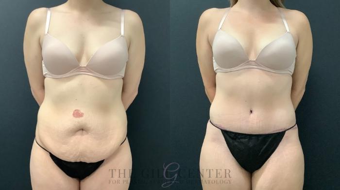Tummy Tuck Case 567 Before & After Front | The Woodlands, TX | The Gill Center for Plastic Surgery and Dermatology