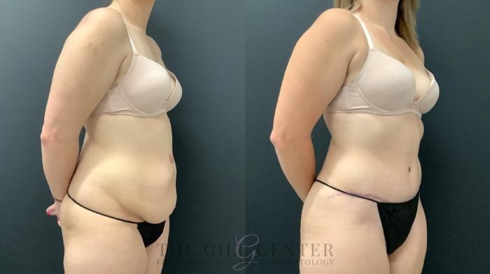 Tummy Tuck Case 567 Before & After Right Oblique | The Woodlands, TX | The Gill Center for Plastic Surgery and Dermatology