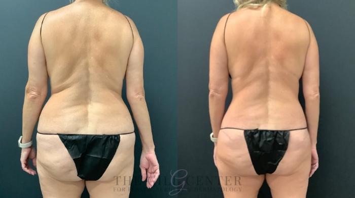 Tummy Tuck Case 568 Before & After Back | The Woodlands, TX | The Gill Center for Plastic Surgery and Dermatology