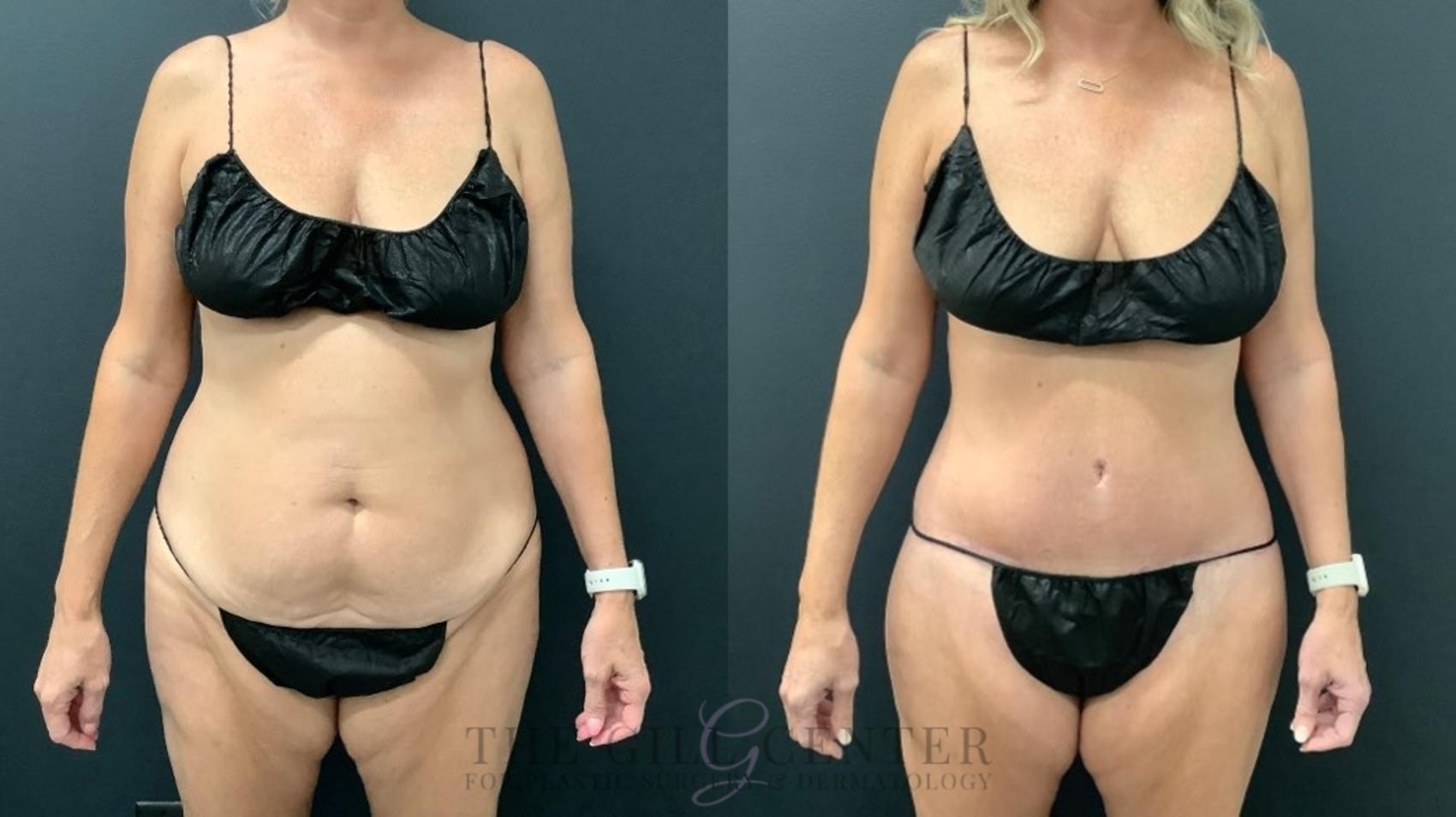 Tummy Tuck Case 568 Before & After Front | The Woodlands, TX | The Gill Center for Plastic Surgery and Dermatology