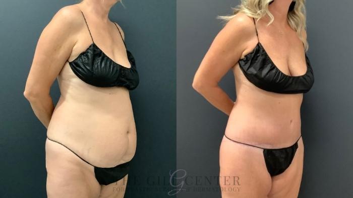 Tummy Tuck Case 568 Before & After Left Oblique | The Woodlands, TX | The Gill Center for Plastic Surgery and Dermatology