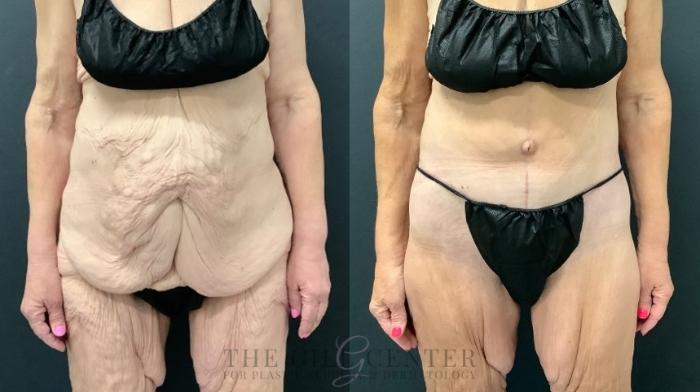 Tummy Tuck Case 569 Before & After Front | The Woodlands, TX | The Gill Center for Plastic Surgery and Dermatology