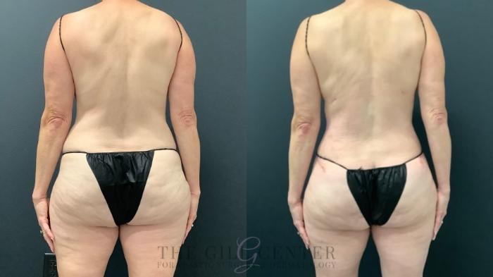 Tummy Tuck Case 582 Before & After Back | The Woodlands, TX | The Gill Center for Plastic Surgery and Dermatology