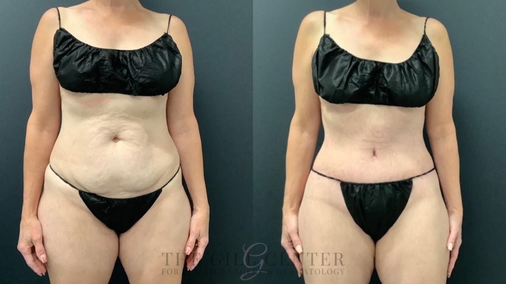 How Much Smaller Will my Waist be After Tummy Tuck Surgery?
