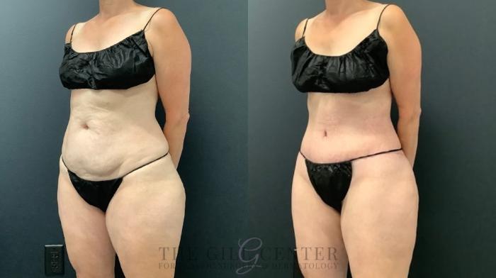 Tummy Tuck Case 582 Before & After Left Oblique | The Woodlands, TX | The Gill Center for Plastic Surgery and Dermatology
