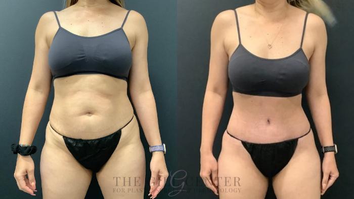 Tummy Tuck Case 587 Before & After Front | The Woodlands, TX | The Gill Center for Plastic Surgery and Dermatology